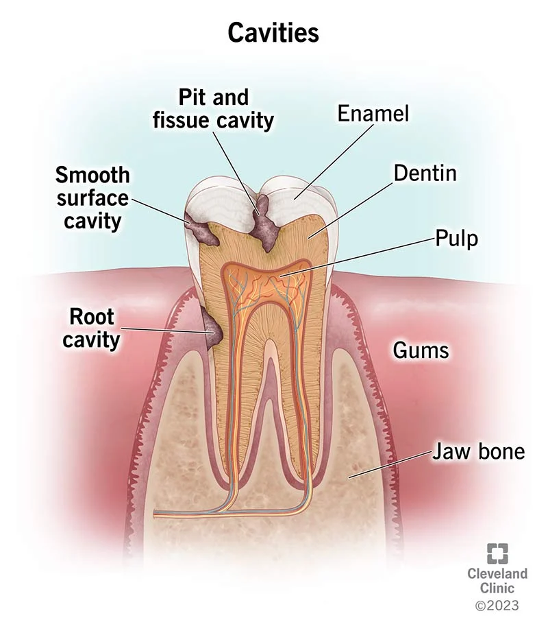 The Threat of Tooth Decay: Causes, Effects, and Solutions