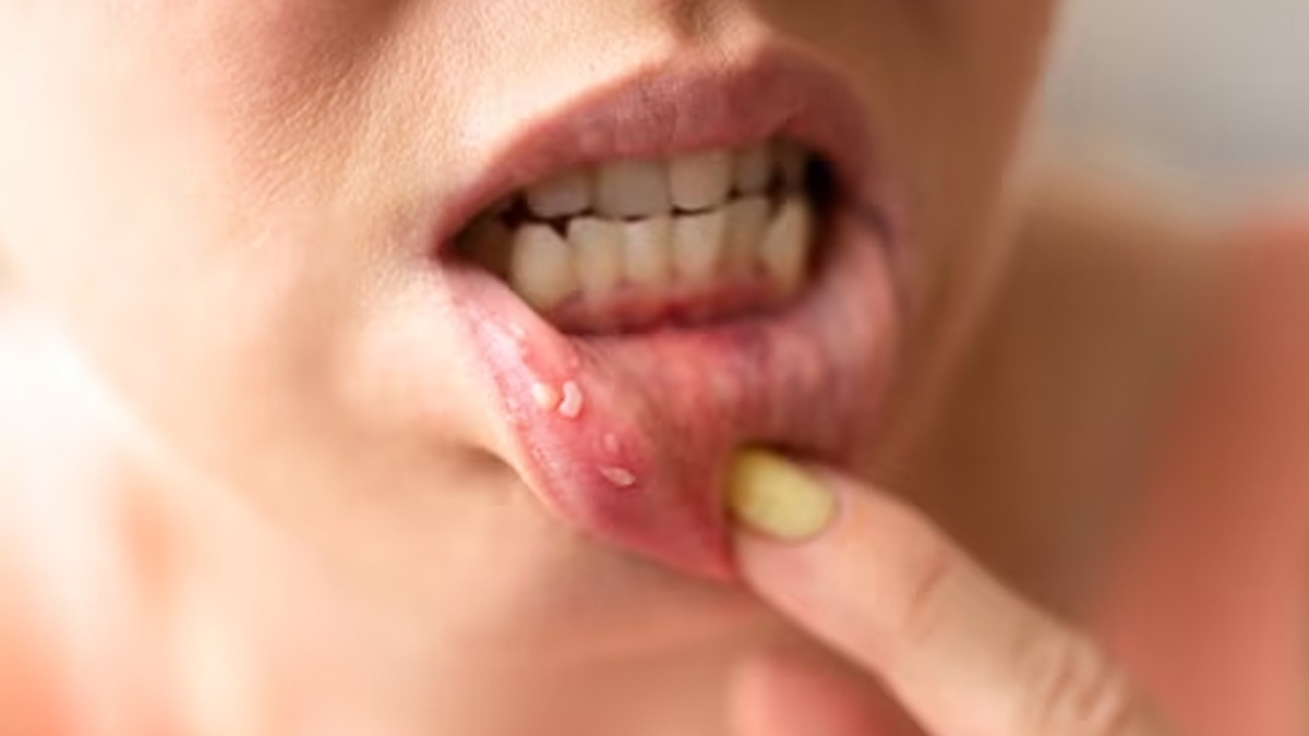 Unveiling Oral Cancer: Risks, Signs, and Early Detection