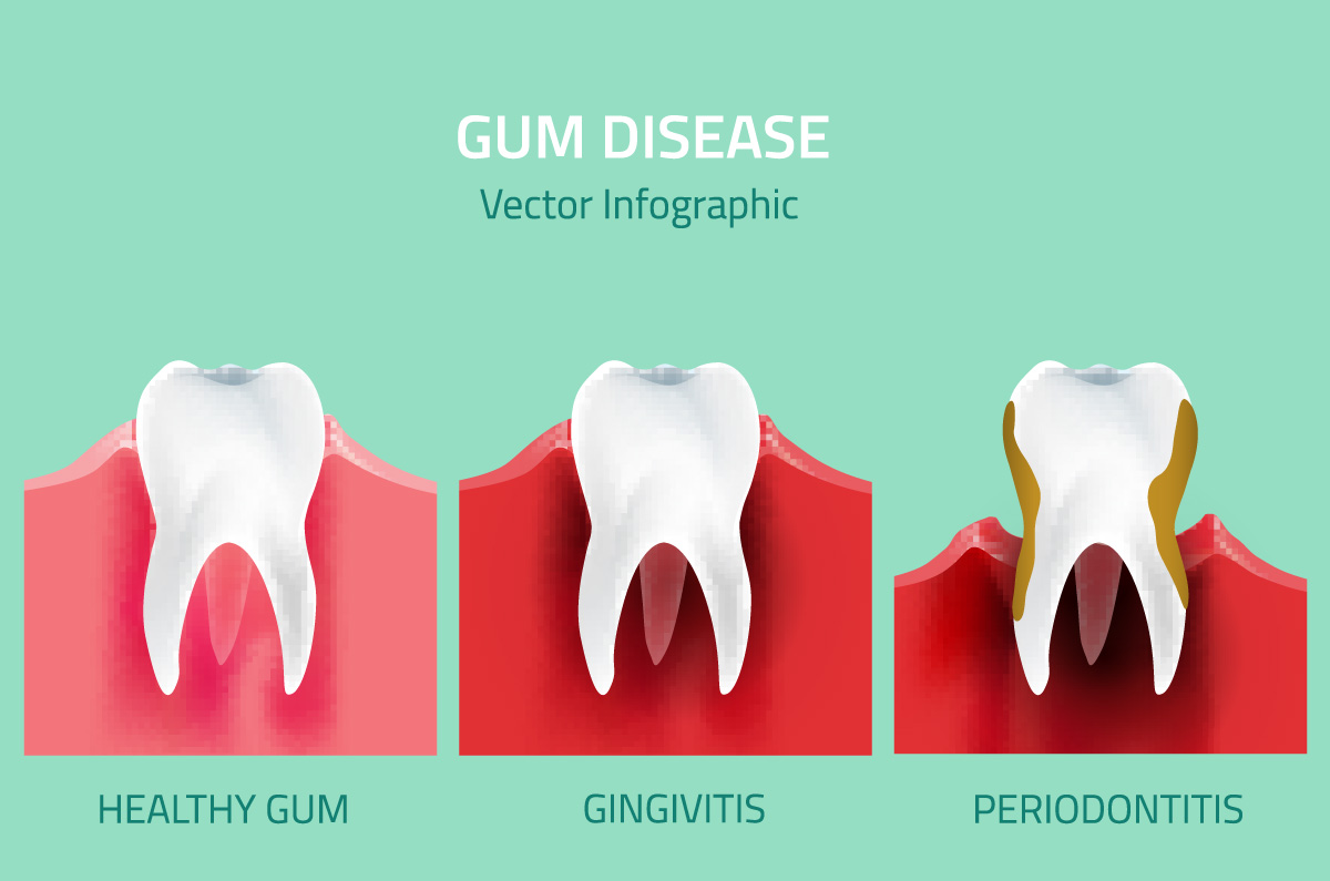 Teeth infographic. Gum disease stages. Editable vector illustration in modern style. Medical concept in natural colors on a light green background. Keep your teeth healthy!